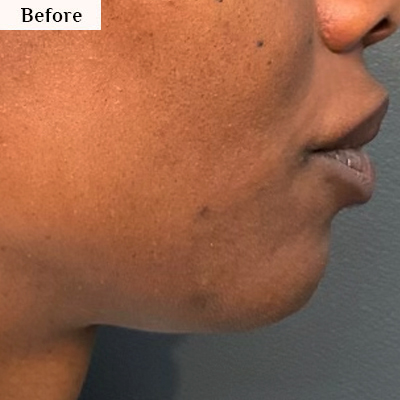 jawline sculting before